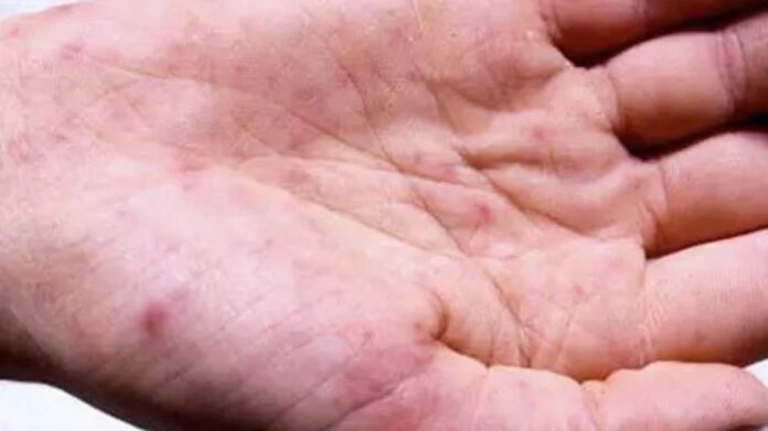 Nagaland Issues Health Advisory After Suspected Meningococcal Disease Case in 14-Year-Old Boy